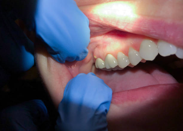 Best Emergency Cosmetic Dentistry (e.g., broken veneers) in St Petersburg, FL